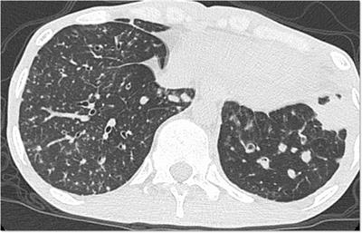 Impaired B-Cell Differentiation in a Patient With STAT1 <mark class="highlighted">Gain-of-Function Mutation</mark>